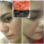 CLEAR ACNE NATURAL SOAP BY ALERT KISS ,REDUCE RED ACNE , ANTI-AGING 80 G.