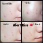 CLEAR ACNE NATURAL SOAP BY ALERT KISS ,REDUCE RED ACNE , ANTI-AGING 80 G.
