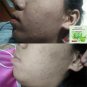 ACNE SOAP 3D SMOOTH ALOE SOAP FOR REDUCE ACNE/STEROID ACNE/ FOR SENSITIVE SKIN