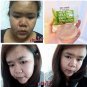 ACNE SOAP 3D SMOOTH ALOE SOAP FOR REDUCE ACNE/STEROID ACNE/ FOR SENSITIVE SKIN