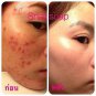 1 BAR x SNAIL WHITE ACNE 10 X SPEED WHITENING & REDUCE ACNE  WITH ZINC. 70 g. ++