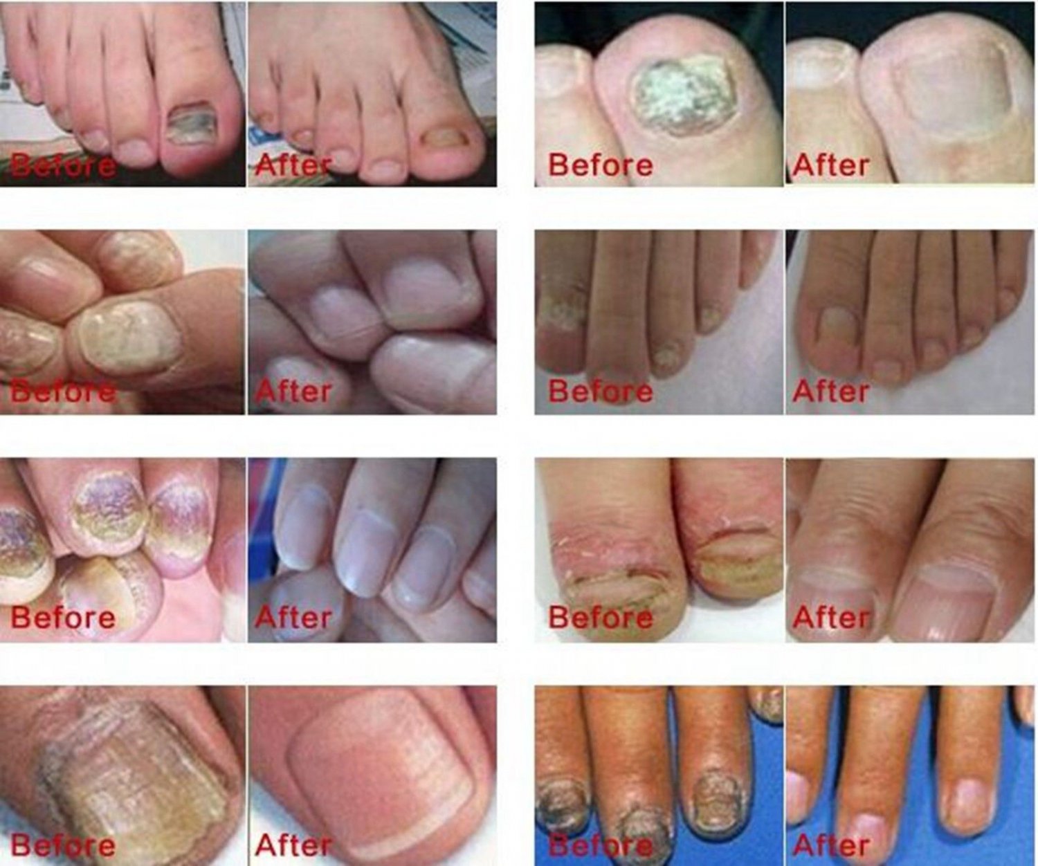 AFY Regeneration Nail Care Polish Oil Gel (Nail Problems Repair)