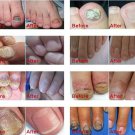 AFY Regeneration Nail Care Polish Oil Gel (Nail Problems Repair)