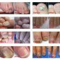 Anti Fungal Nail Treatment Toe Nail Finger Fungus Onychomycosis Thickened 30ML