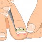 Ingrown Toenail Protector Straightener&acirc;�� Clip Curved Toenail Correction Pedicure