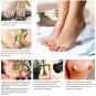 5pc Ingrown Toe Nail Fixer Pedicure Toenail Recover Correction Manicure Care Kit