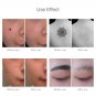 ORIGINAL! NEATCELL Laser Spider Veins Acne Mole Warts Freckles Remover-FULL KIT