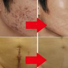 Treatment Stretch Cream Scar Marks Skin Remove Mark Acne Remove Spots Oil