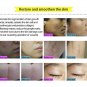 Scar Cream 100 Ginseng Extract Removing Bleaching Acne Remover Original PRD 0174