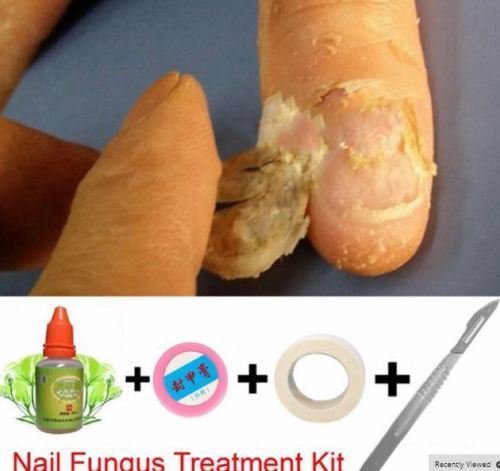 Chinese Medicine Herbs Toe Nail Fungus Treatment Anti Fungal Nail Infection Kit