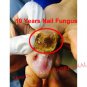 Chinese Medicine Herbs Toe Nail Fungus Treatment Anti Fungal Nail Infection Kit