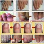 Chinese Medicine Herbs Toe Nail Fungus Treatment Anti Fungal Nail Infection Kit