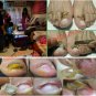 Chinese Medicine Herbs Toe Nail Fungus Treatment Anti Fungal Nail Infection Kit