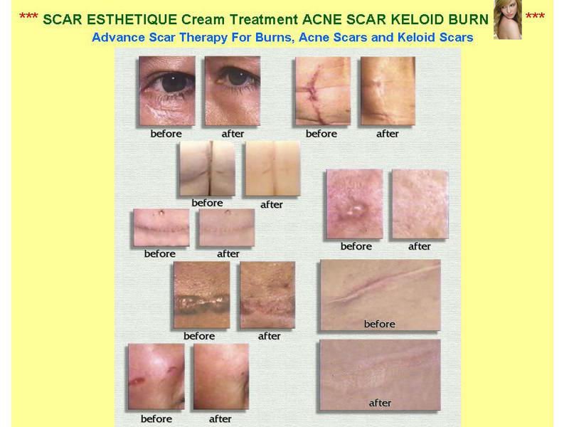 3x Scar Esthetique Cream SCAR THERAPY Treatment fade Burns KELOID ACNE SCAR 4g.