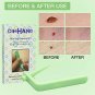Premium Micro Skin Tag Remover Device - Skin Tag Removal Kit Remove Small to Med