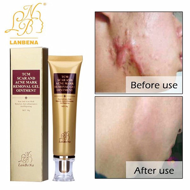 30g TCM SCAR AND ACNE MARK REMOVAL GEL OINTMENT (LanBeNa) Acne Scar Cream