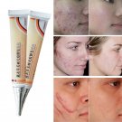 Face Pigmentation Cream Anti Acne Spots Scar Removal Repair Oily Skin Care