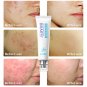 BAIMISS Acne Cleaning Cream Skin Care Remove Repair Comedone Pimple Acne