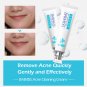 BAIMISS Acne Cleaning Cream Skin Care Remove Repair Comedone Pimple Acne