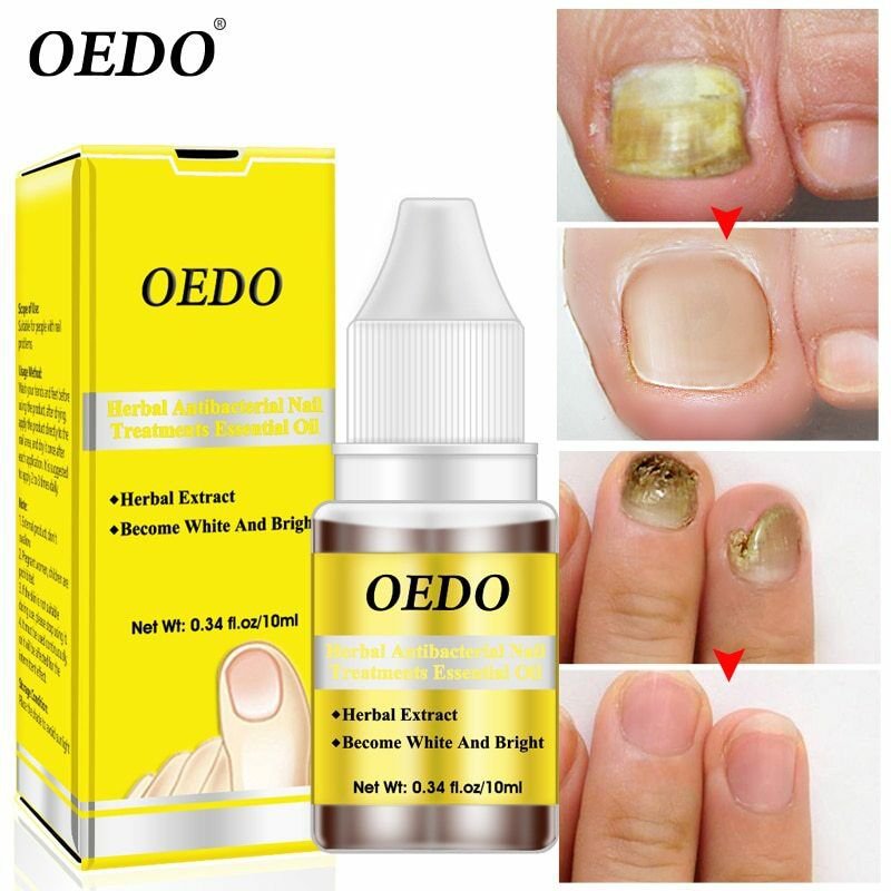 Herbal Antibacterial Nail Treatments Essential Oil Herbal Extract Nail
