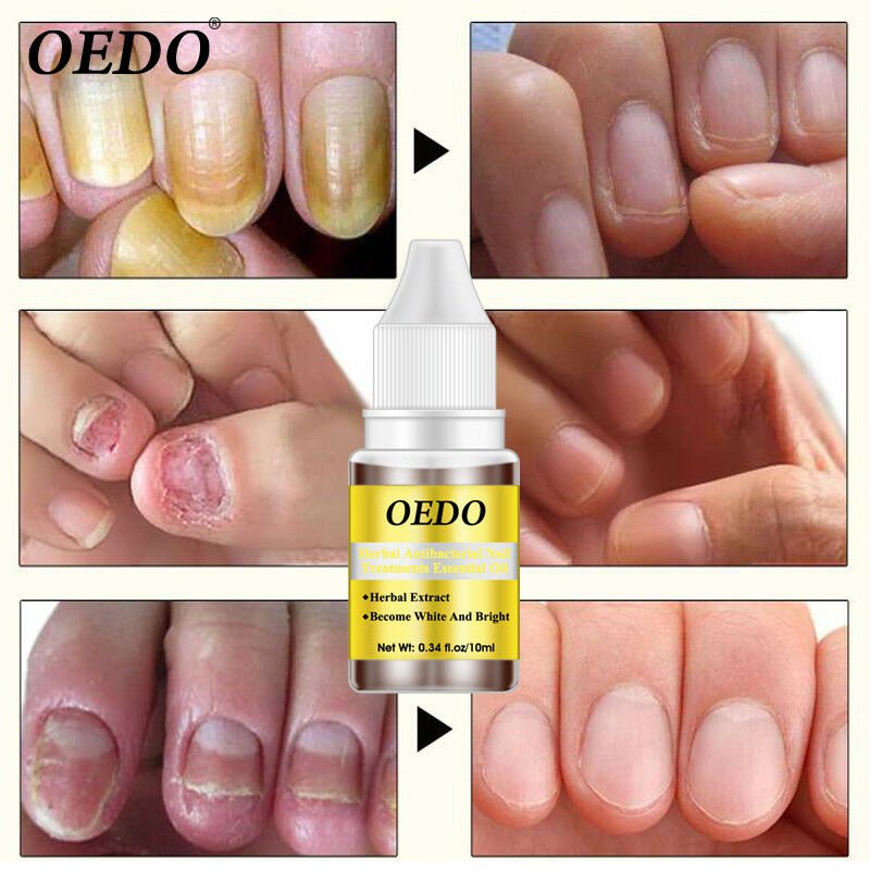 Herbal Antibacterial Nail Treatments Essential Oil Herbal Extract Nail