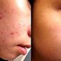 Kuan Im x3 Skin Whitening Lightening Melanin Acne Prevent Blackheads Whiteheads
