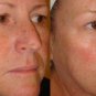Arche Pearl Cream x2 Skin UV Whitening Melasma Acne Beeswax Blackhead Whiteheads