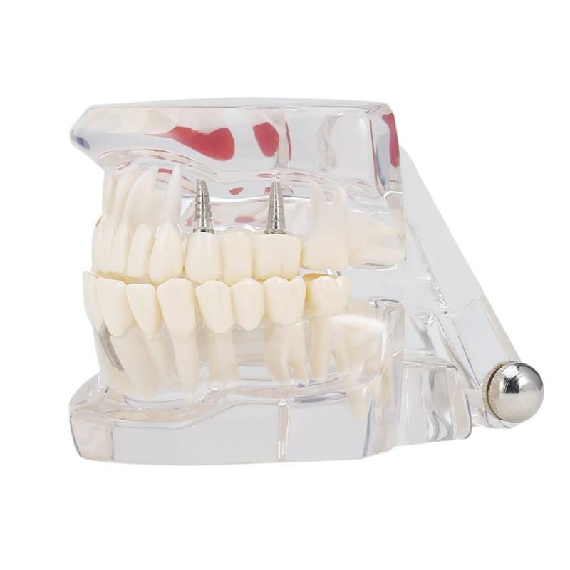 Professional Detachable Tooth Teeth Disease Moldel Dental Implant Display