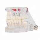 Professional Detachable Tooth Teeth Disease Moldel Dental Implant Display