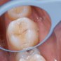 HAHNENKRATT DENTAL RELAX FS Rhodium Mouth Mirrors REF 7110-size 5 10 ASSORTMENT