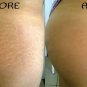 Mamaearth Body Creme for Stretch Marks and Scars, 100ml