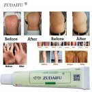 New Zudaifu Skin Care Eczema Dermatitis Psoriasis Chinese Herbal Body Asia Cream
