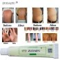 New Zudaifu Skin Care Eczema Dermatitis Psoriasis Chinese Herbal Body Asia Cream