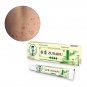 Zudaifu Dermatitis Eczematoid Eczema Ointment Treatmen Psoriasis Cream