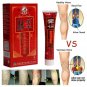 Crema Para Las Varices Tratamiento Para Eliminar Y ALIVIAR Dolores ¡FUNCIONA!