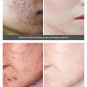 Crema Para Manchas En La Cara BLANQUEA Tu Piel Rápidamente Y OLVIDA Las Manchas