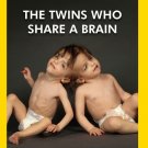 The Twins Who Share a Brain [DVD]