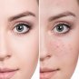 Bye Bye Blemish for Acne Drying Lotion 29.5ml/1oz Basic