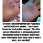 Thyme Out The Knockout Alternative For Eczema, Psoriasis, Acne, Dermatitis, R...