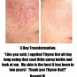 Thyme Out The Knockout Alternative For Eczema, Psoriasis, Acne, Dermatitis, R...