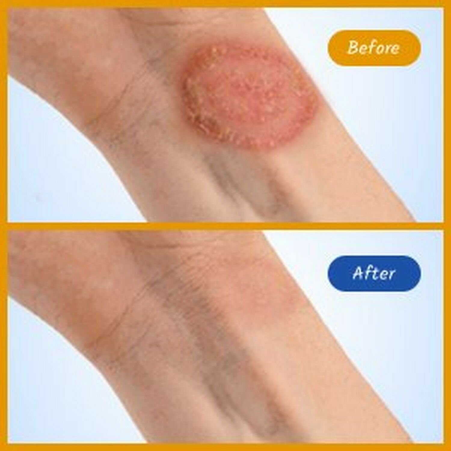 Phytozine Organic Anti Fungal Ringworm Cream for Humans, Eliminates and