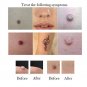 2018 Electric Laser Age Spot Pen Mole Warts Freckle Scars Removal Machine