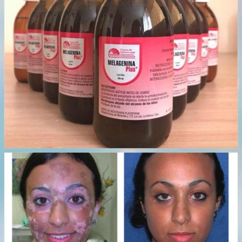Melagenina Plus + Body Lotion for Vitiligo Treatment + 8 fl oz Original