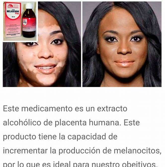 Melagenina Plus + Body Lotion for Vitiligo Treatment + 8 fl oz Original