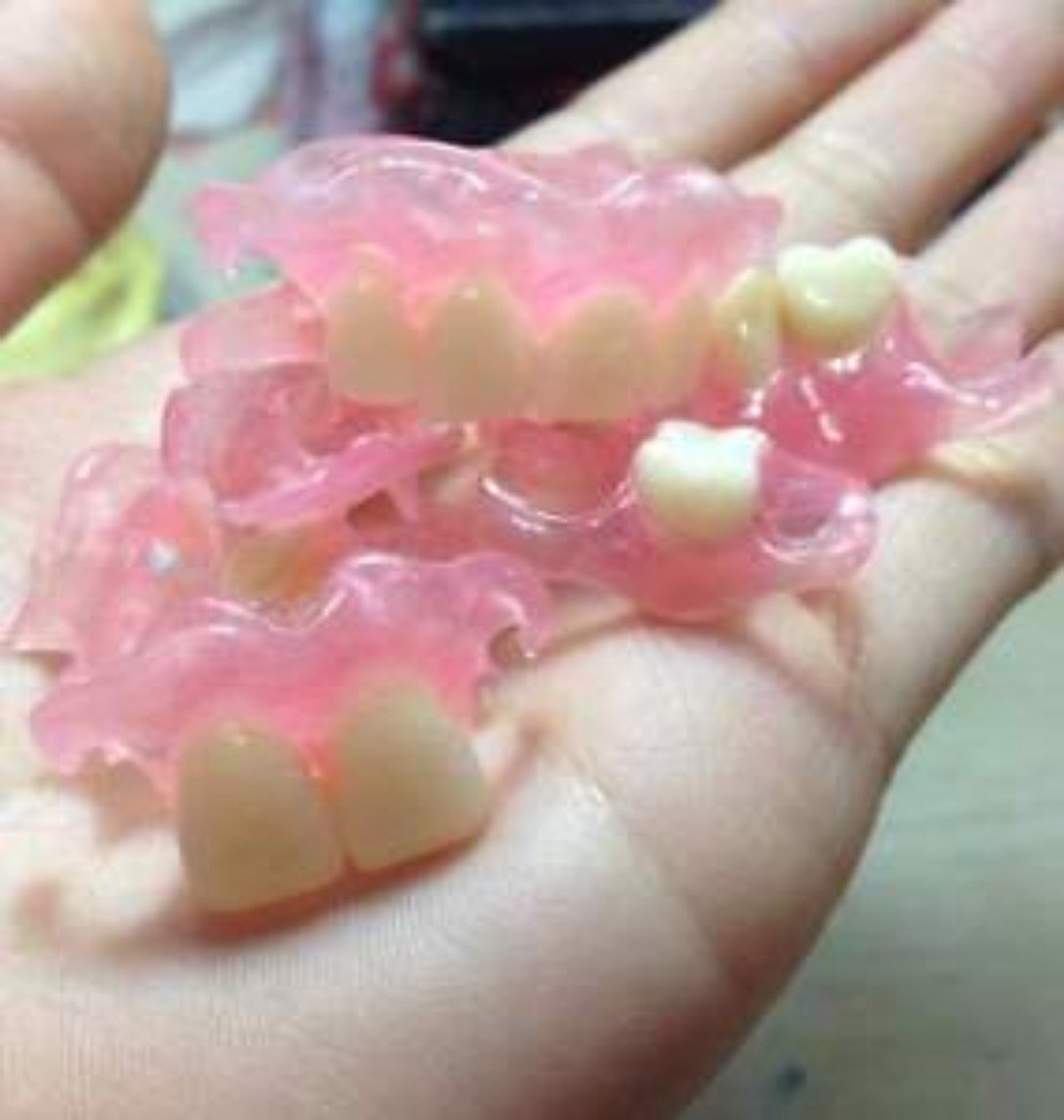 Affordable Flexible Valplast Customized Partial Denture (Pink, Valplast)