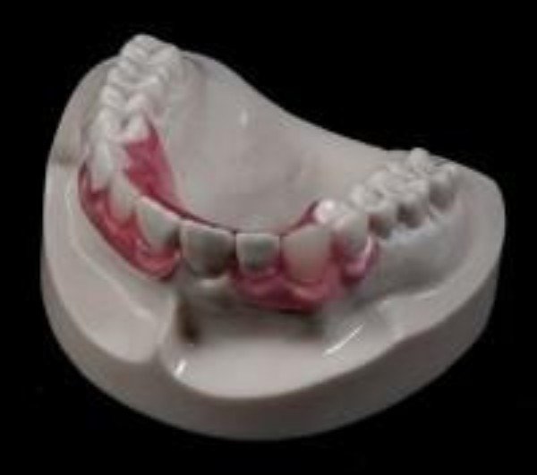 Affordable Flexible Valplast Customized Partial Denture (Pink, Valplast)