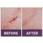 Mederma Advanced Plus Scar Gel 5 gm