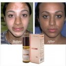 Melgain Lotion for Vitiligo White Spots Patches Re Pigmentation 5ml
