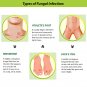 Tetmosol Anti-fungal Dusting Powder 100gm Pack of 2 for Fights skin infections, Itching