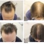 FOLLICLE-REBOOT